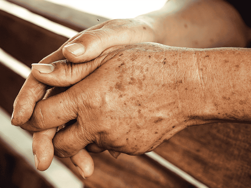 Age Spots Removal | Canterbury Skin and Laser Clinic