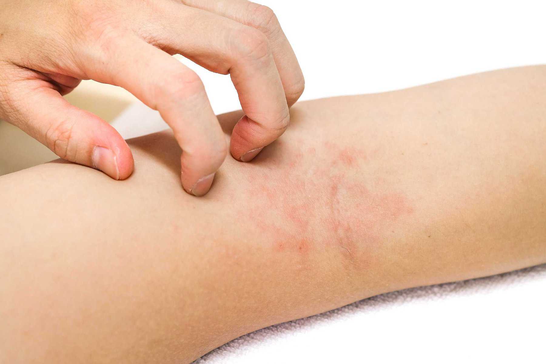 Eczema | Canterbury Skin and Laser Clinic