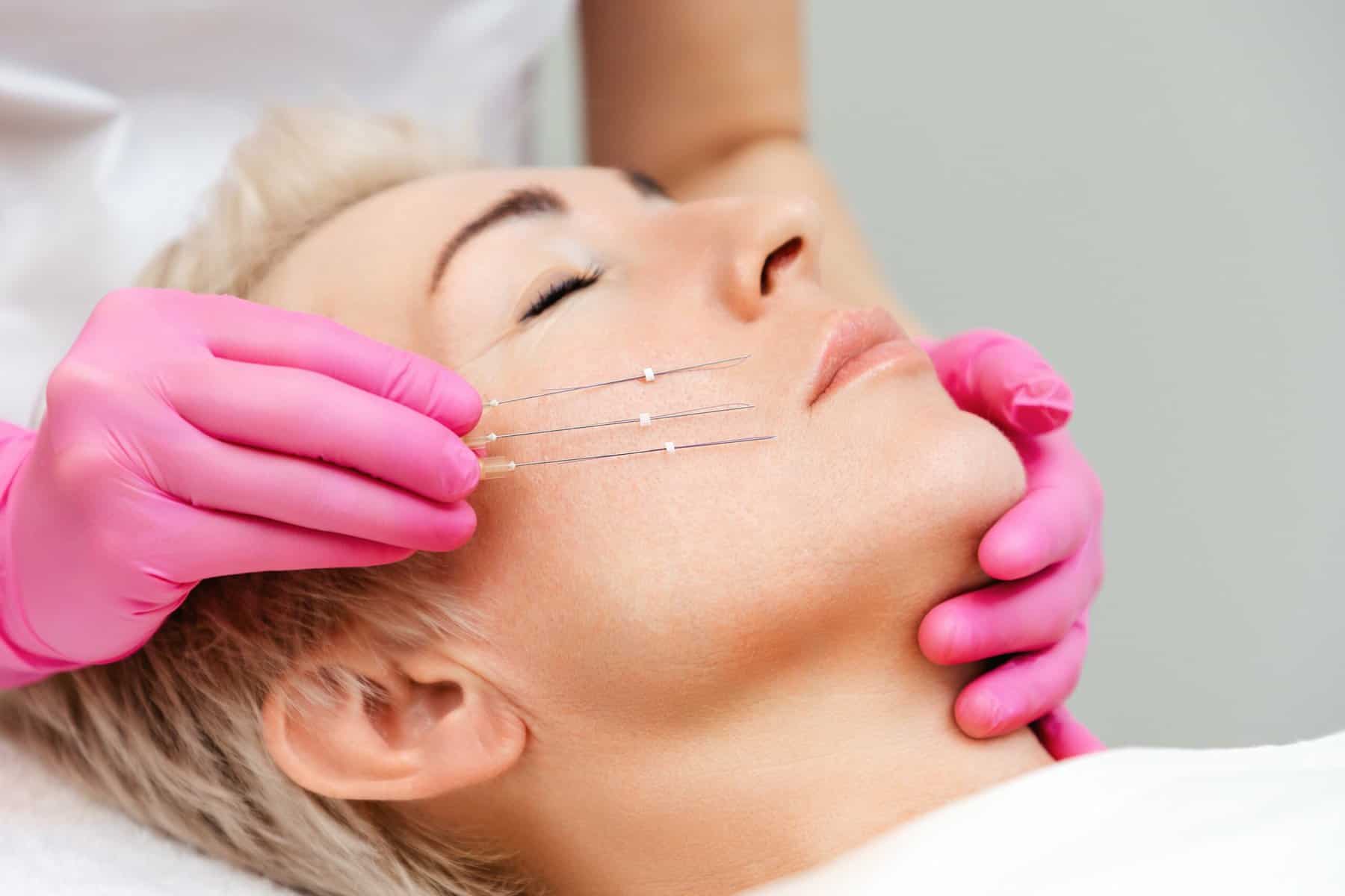 PDO Thread Lift Treatment | Canterbury Skin and Laser Clinic