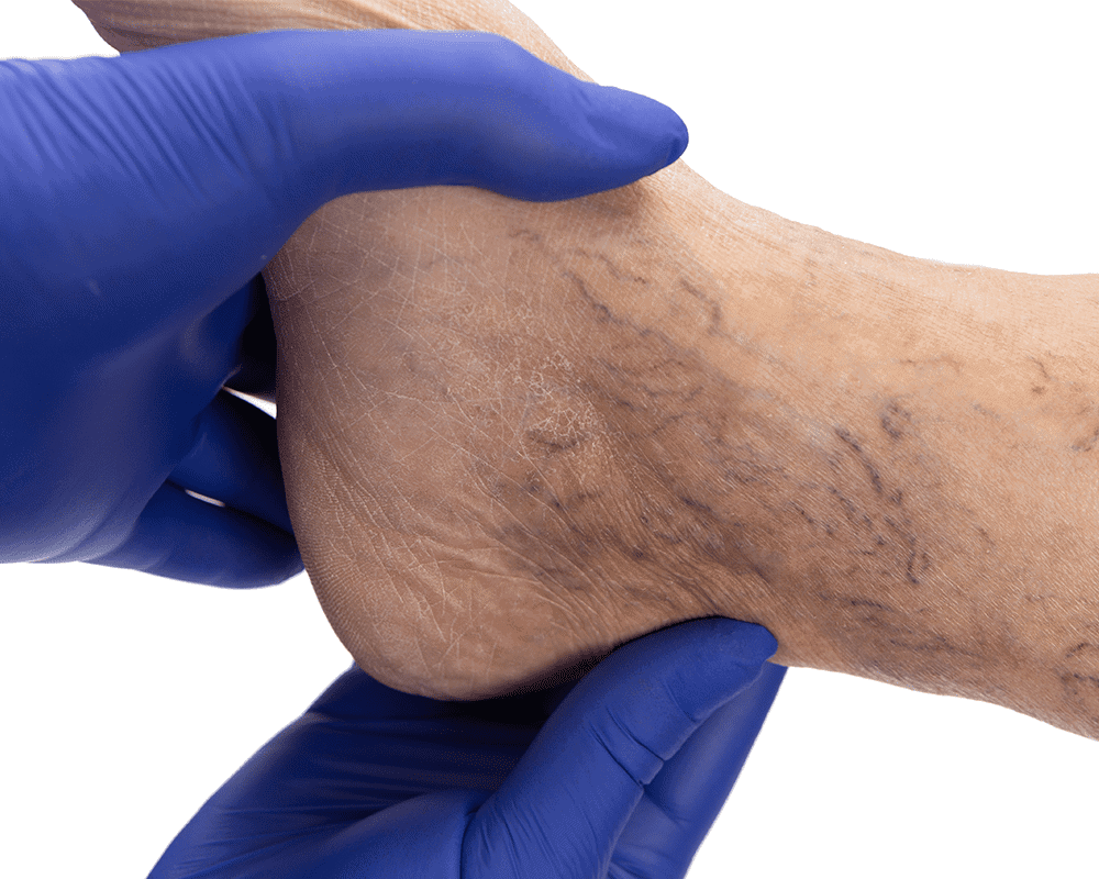 Varicose Veins Treatment Canterbury Skin and Laser Clinic
