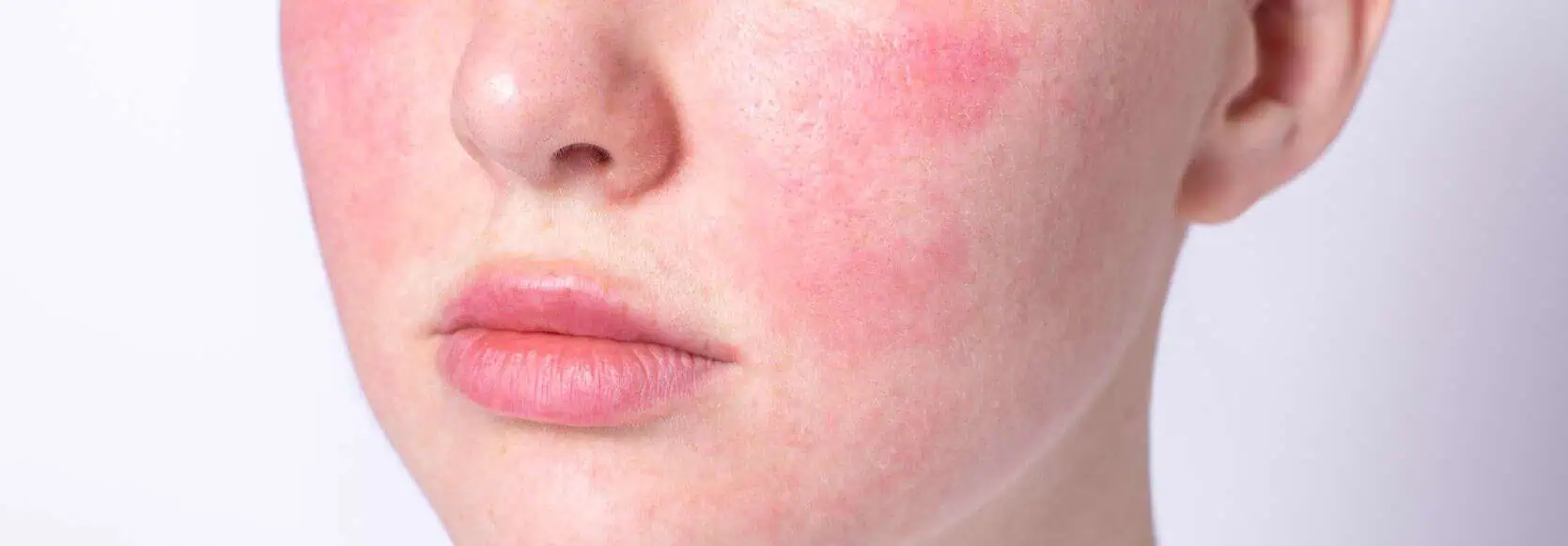 Rosacea awareness month