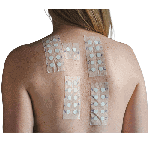 Skin Allergy Patch Test in Canterbury