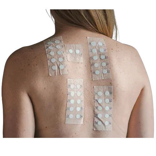 Skin Allergy Patch Test in Canterbury