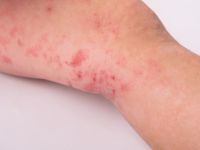 itchy skin allergy