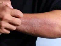 skin allergy