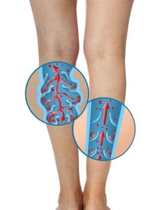 varicose veins