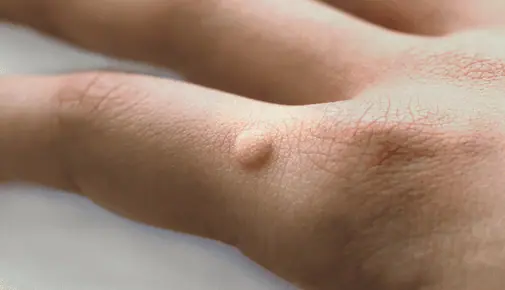 Verruca Removal